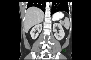 Breast tomosynthesis dose