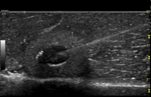 Breast tomosynthesis dose